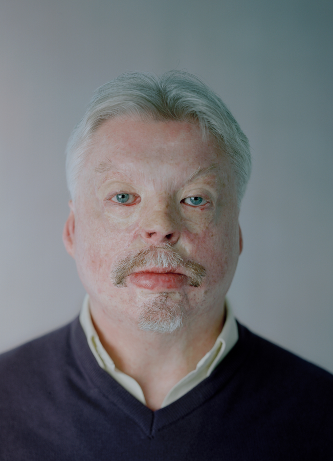 Simon Weston CBE sustained burns as a result of enemy action in the Falklands War.