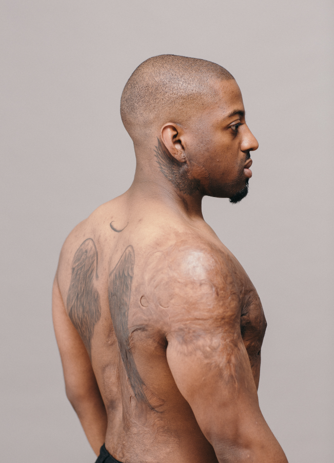 Justyn Hollet displaying his scars from third degree burns over his neck and upper body